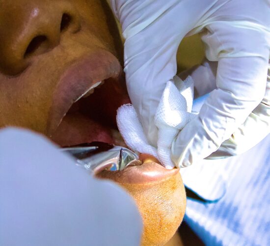 Extractions de Dents
