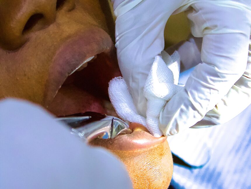 Extractions de Dents